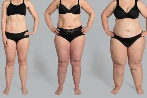 Três mulheres com diferentes níveis de lipedema
