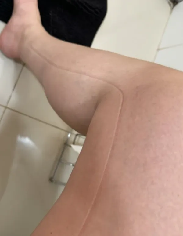Exemplo de marcas e hematomas